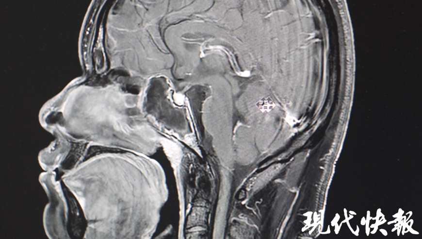 14岁男童鼻子发霉引发过敏性鼻炎，专家解读过敏性鼻炎的特殊类型