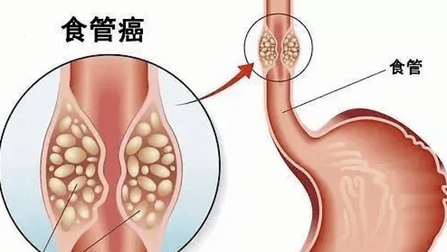 探索新型检查手段：年年体检为何还会被查出食管癌？

早发现癌症，需关注哪些癌症标志物的异常？