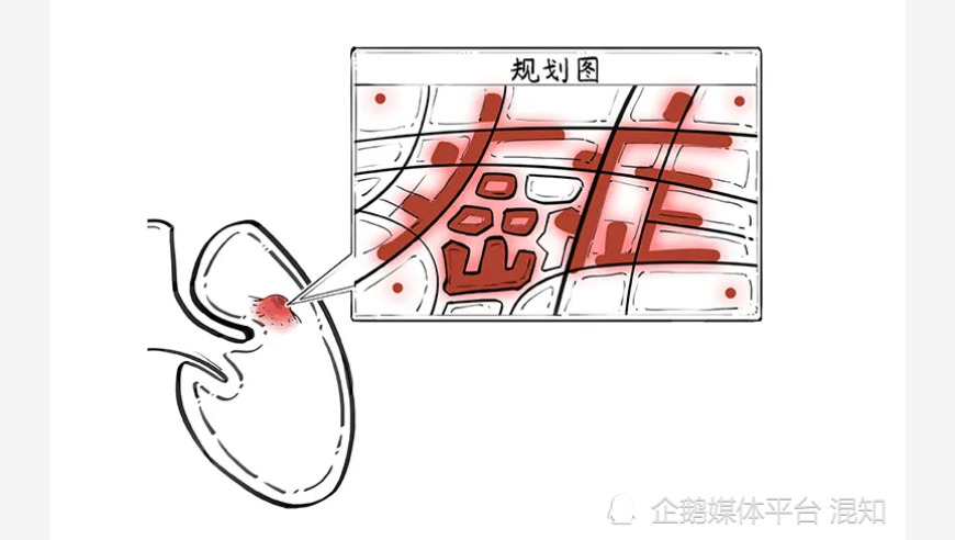 探索结节的病因与风险因素，是离癌症还有一段距离吗？