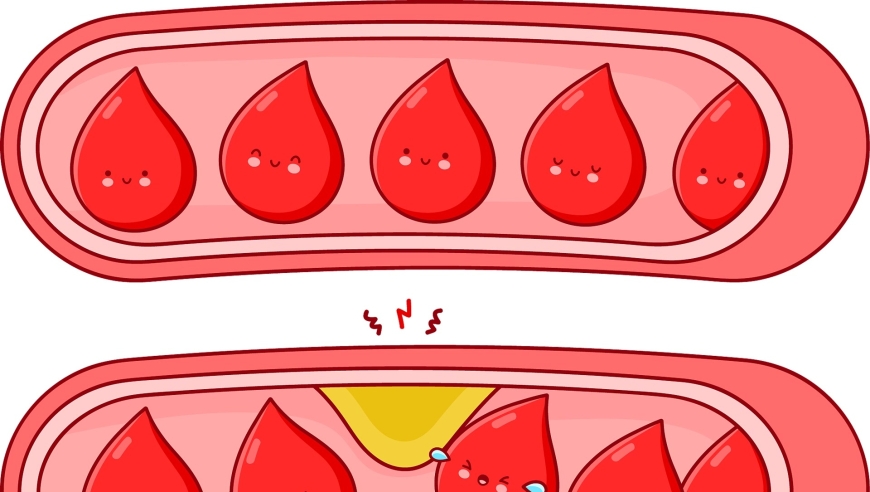 提高健康：避免这些行为可能导致血管堵塞！