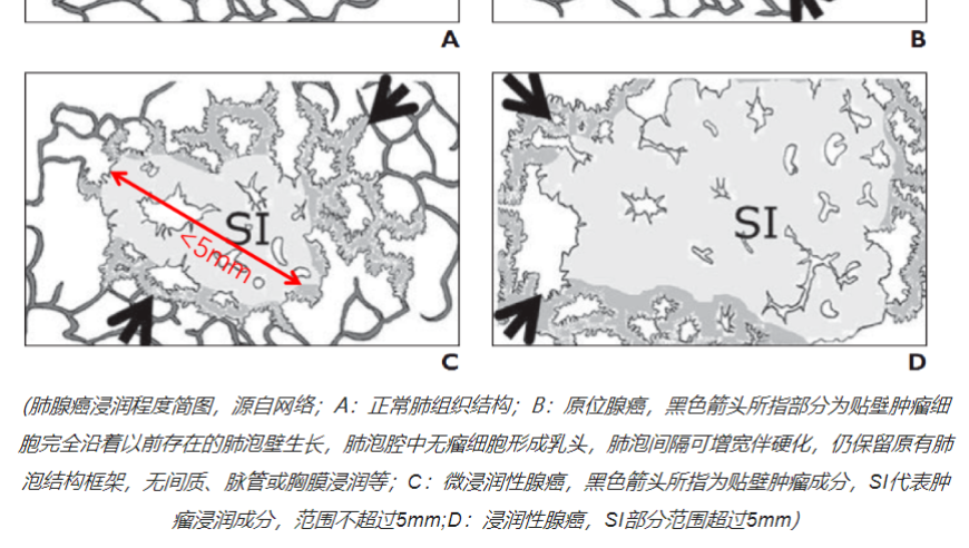 揭秘肺癌术后病理报告，让你了解每个细节