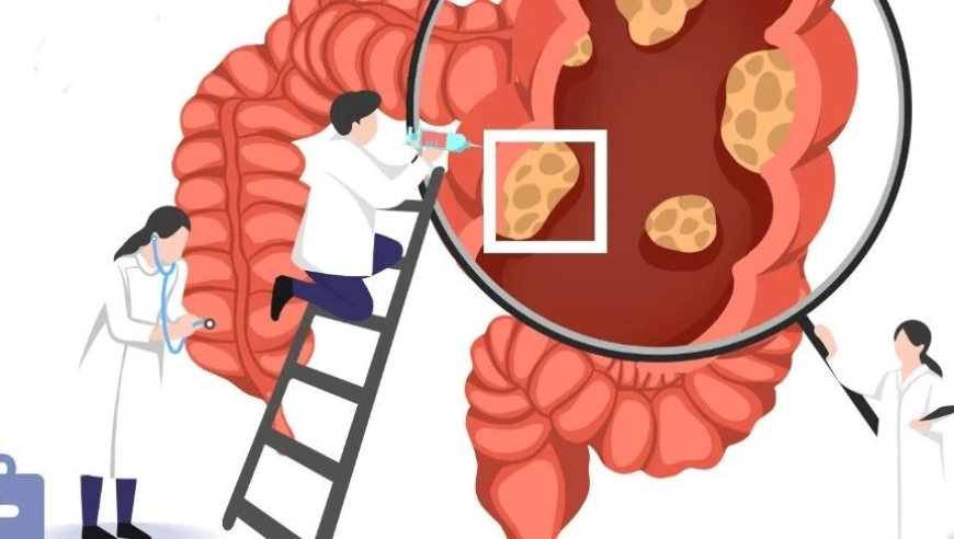 结直肠癌筛查的最佳时机：哪些人群需尽早关注？

或者

及时就医：结直肠癌的早期预警信号是什么？请看这些人群需要重点关注！

结直肠癌筛查的最佳时间：错过最佳筛查时间会怎样？这四个因素要务必了解！