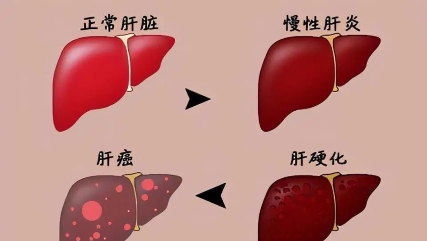 乙肝抗病毒治疗与肝硬化的关联探讨