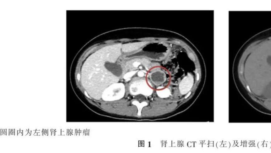 【病例解析】MAX基因突变与儿童嗜铬细胞瘤：一种特殊案例及文献回顾