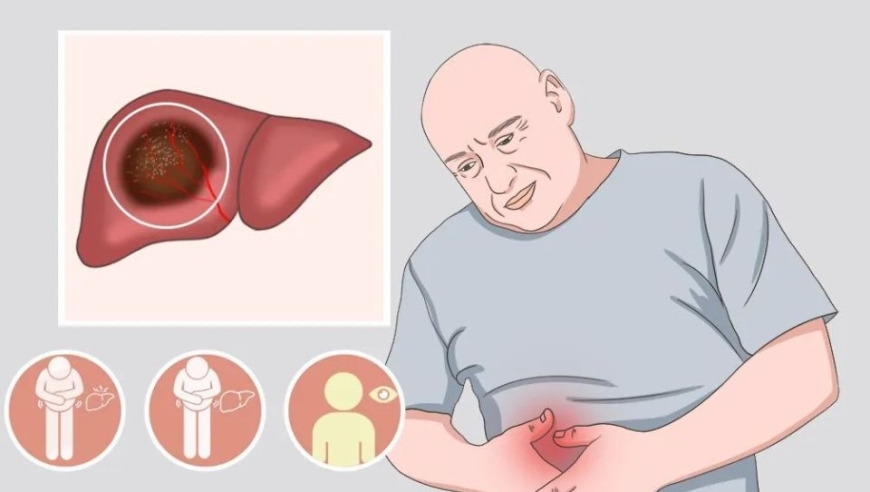 如何发现肝癌的早期信号？不被忽视的小细节就是肝脏预警器！