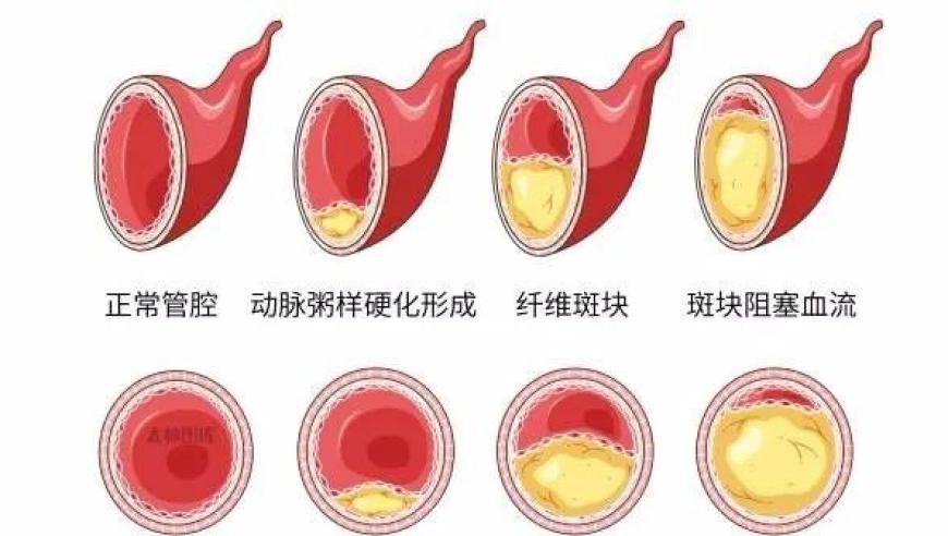 全面了解颈动脉斑块：检查结果与治疗建议全知道！