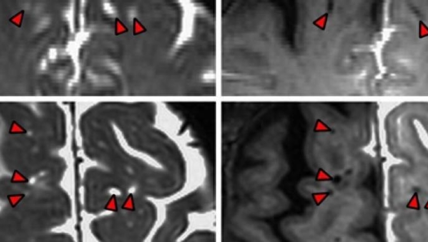 科学家揭示：人类大脑的新貌——第一次绘制的人类大脑排水系统图