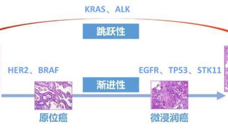 广东肺癌专家的新发现：肺结节与基因种子密切相关，进一步揭示疾病风险因素