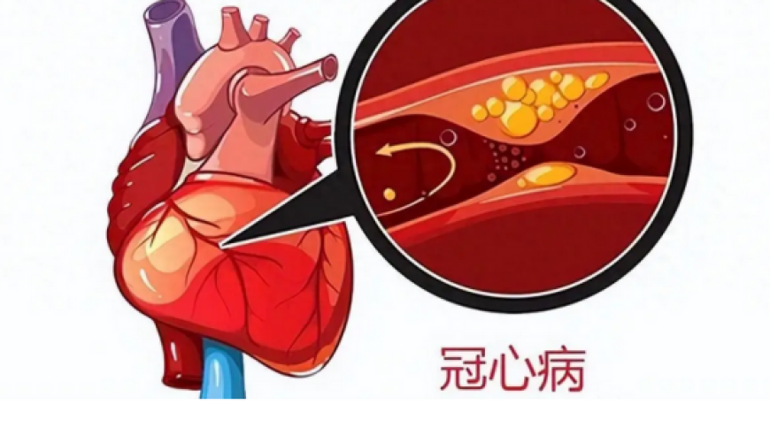 全面解析冠心病防控知识，早知早预防，让健康轻松掌握