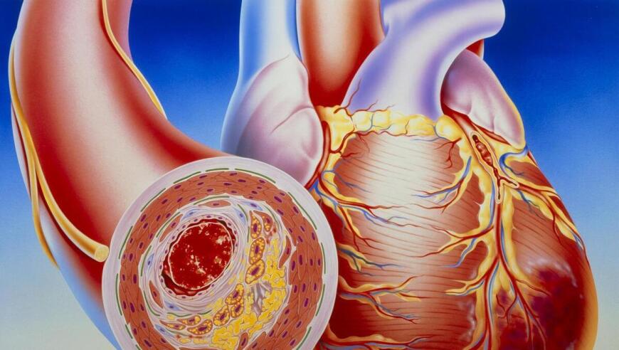 10个关于心脏病的专业名词解释：狭窄、硬化、钙化、堵塞与它们的区别是什么？