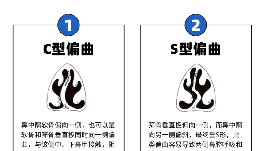 警惕！鼻塞、流鼻涕并非一定是感冒、鼻炎，更需关注这潜在的风险