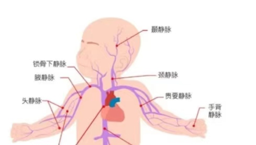 头皮留置静脉针后，宝宝哭闹15小时原因揭秘：全新解决方案揭晓