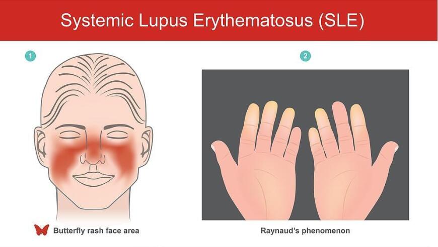 专家解读：红斑狼疮≠致命威胁，适度干预可有效控制病情