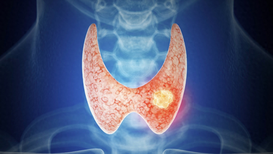 中老年女性警惕：如何做好甲状腺癌的早期预防？遇到哪些症状应立即就医？
