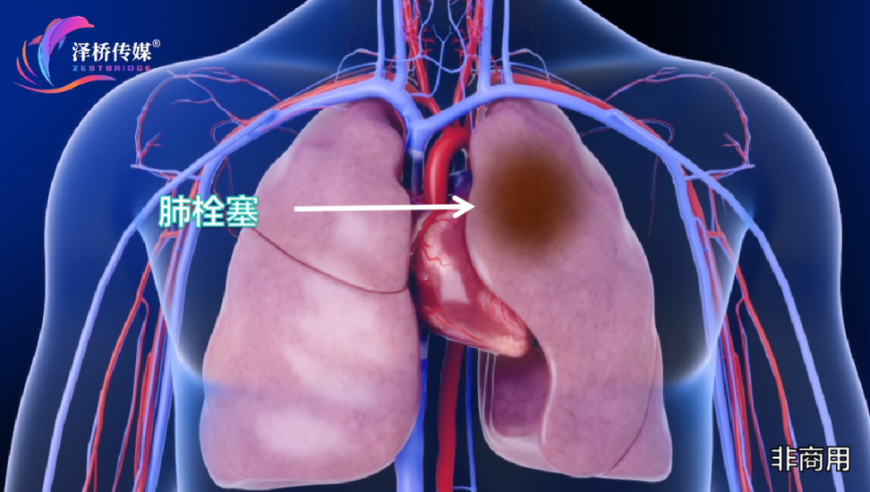 理解并掌握肺栓塞症状，一目了然地辨别吸入障碍疾病：五个关键要点