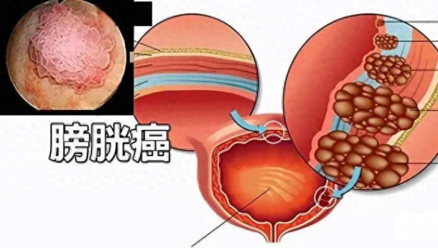 关注7个风险因素，了解预防膀胱癌的策略——戒烟，早筛至关重要