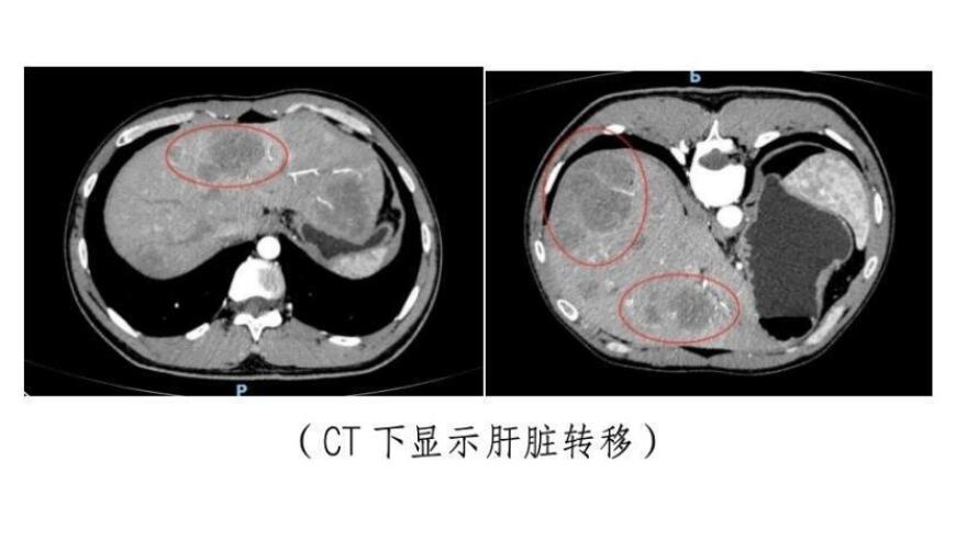 失去妹妹的弟弟患上肠癌，医生揭示家族遗传高达50%的几率