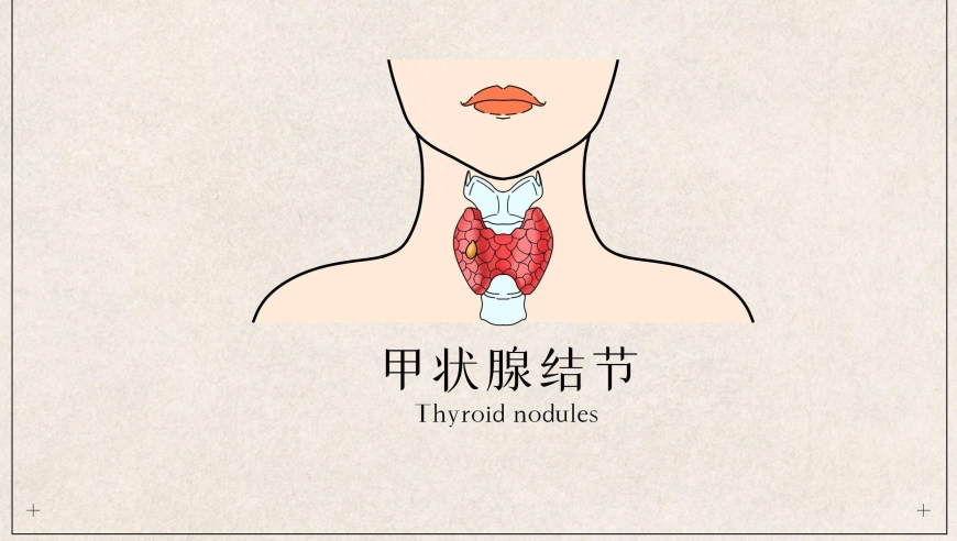 警惕颈部肿块与吞咽困难，甲状腺结节：关键在于早筛查！