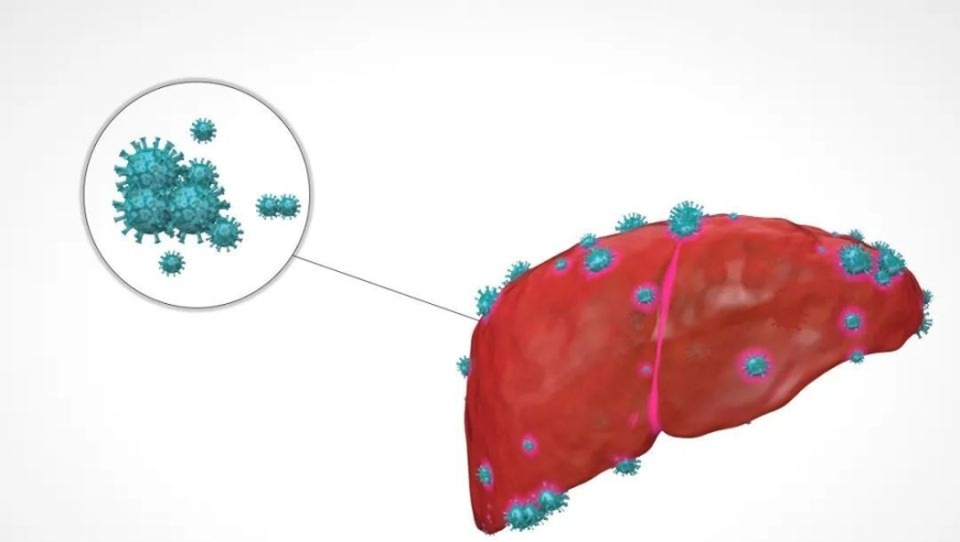 您是否有对肝脏的警示？一次、两次或三次？了解乙肝为何引发肝癌的关键信息
