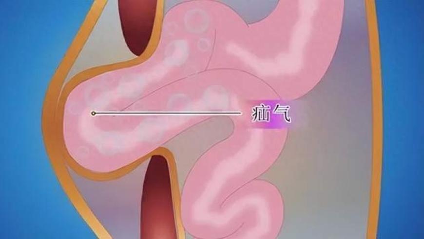 网上查看：了解腹股沟疝的常见原因、危害及是否需手术治疗？