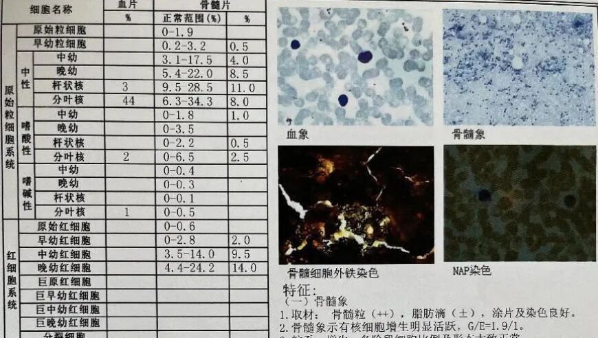 弥漫大B淋巴瘤继发急性白血病病例分享：一个患者的深度历程与治疗方法探讨