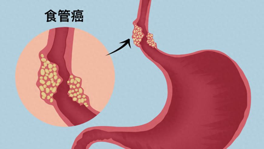 早期警惕：这六类人群须关注食管癌潜在风险！防护措施要做好