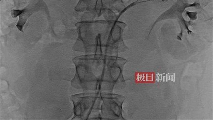 微创手术：探索突破性的降压疗法，解决难治性高血压难题