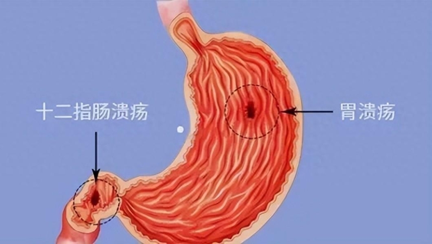 1. 发现五大症状：胃溃疡的危险信号，早治早好
2. 警惕这些常见的消化系统问题：可能有胃溃疡
3. 寻找你的消化溃疡预警信号：5个关键警示信号
4. 预防胃溃疡：了解常见症状和解决方案
5. 寻求专业帮助：如果你发现自己有胃溃疡的症状