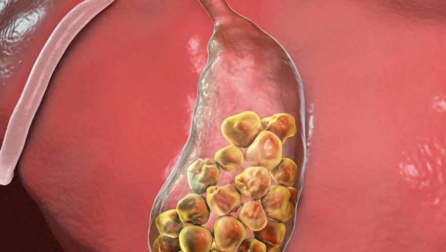 六类人群需警惕胆结石风险，早期发现、筛查至关重要!