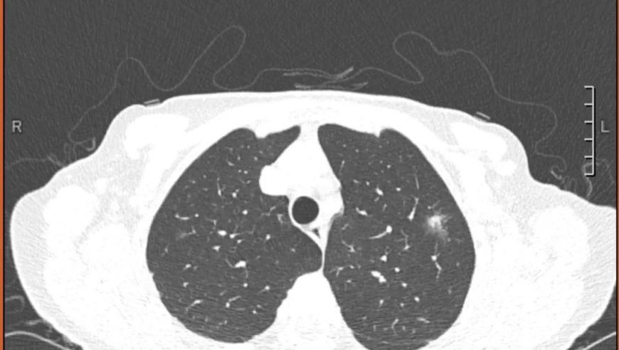 大半年增长11毫米 肺结节疑癌，您需注意观察