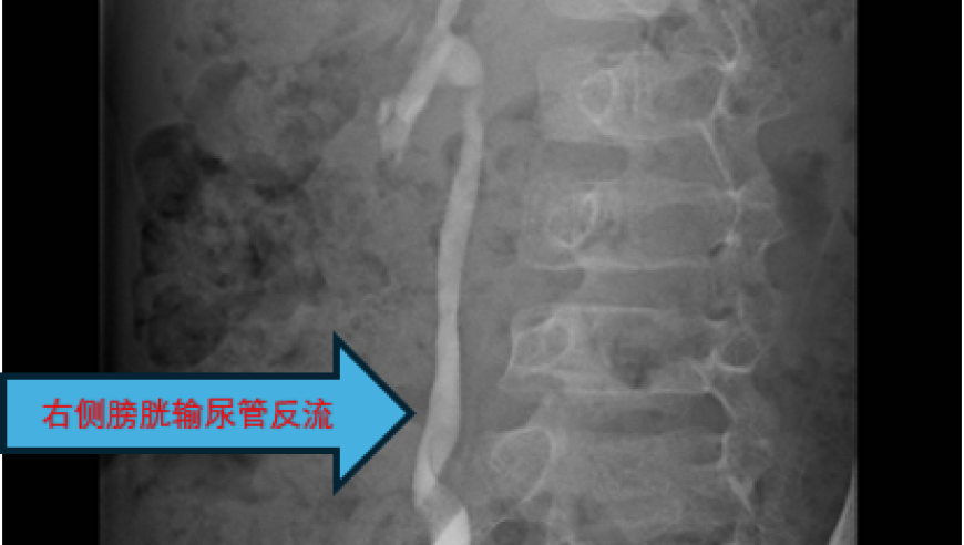 小宝宝反复发烧可能是泌尿道感染？如何识别并治疗这个问题?