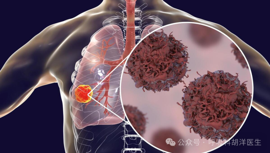 不要轻易被肺部结节疑诊：简单方法解析肺癌的早期信号