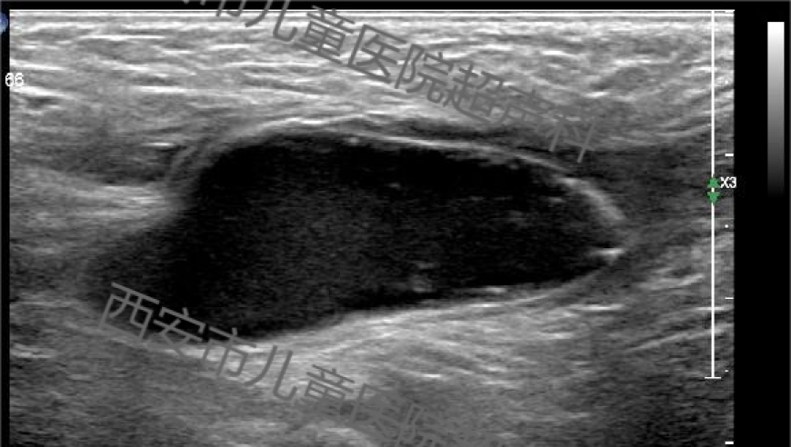 让孩子大腿根部包块？「疝」是什么，严重后果你知道吗？