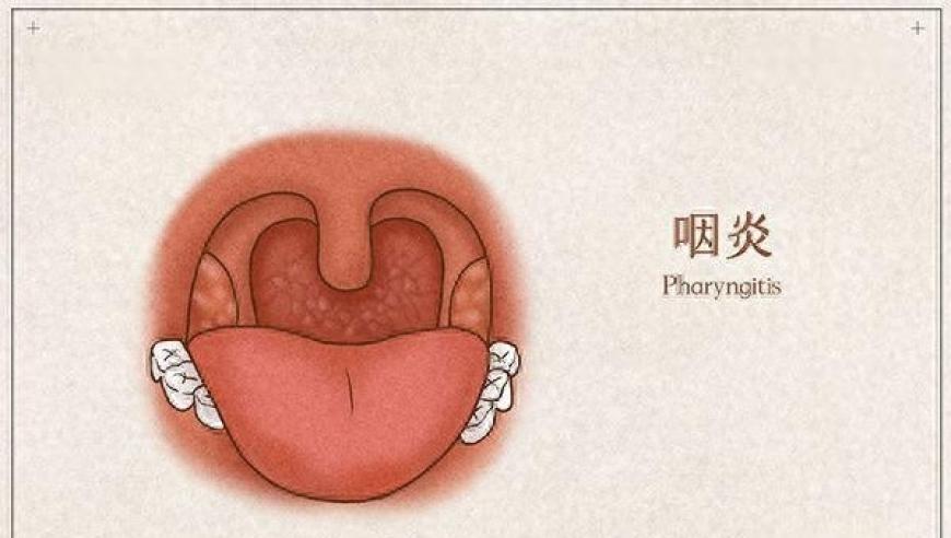 避免因不良生活习惯导致的急性咽炎：防范六大因素与五个关键护理措施