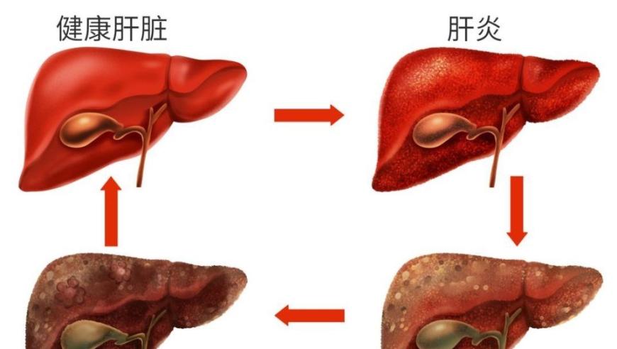 如何有效避免高风险人群成为肝癌的目标？4类人应特别关注并采取预防措施