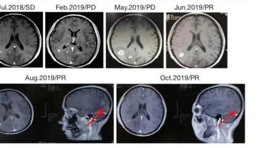 一名成功抵抗肺癌脑转移，实现长寿目标的32岁女士：从绝望到重生的故事