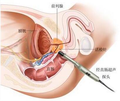 国产厂商患上前列腺癌的原因与困境：夹击凸显