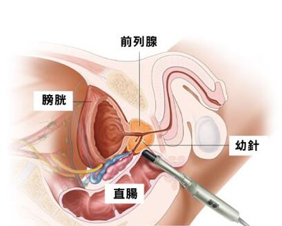 国产厂商患上前列腺癌的原因与困境：夹击凸显