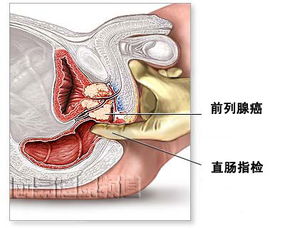 国产厂商患上前列腺癌的原因与困境：夹击凸显