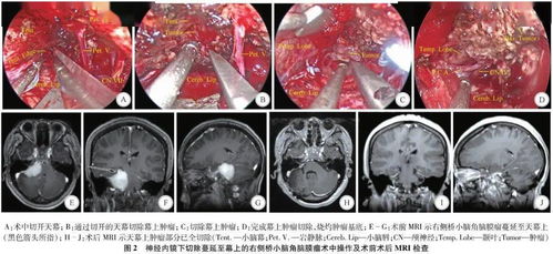 中国首例神经外科精准医疗手术探索脑胶质瘤新疗法零的突破