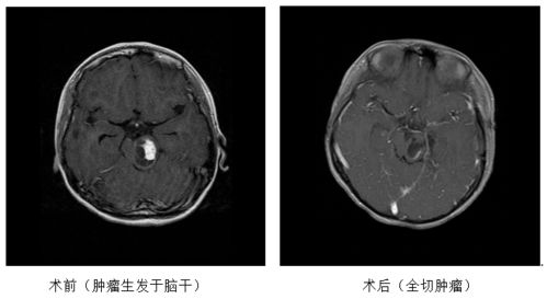 中国首例神经外科精准医疗手术探索脑胶质瘤新疗法零的突破