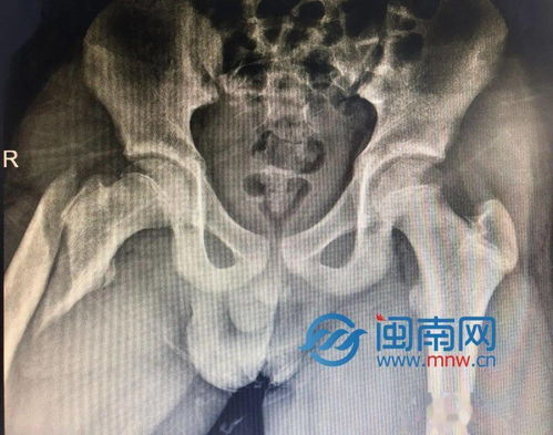 14岁男孩肺内疑似肿瘤 结节，需要进一步检查与治疗吗？