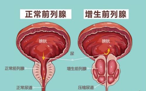 把握前列腺增生的早期预警信号，进行10项预防措施，守护男性健康