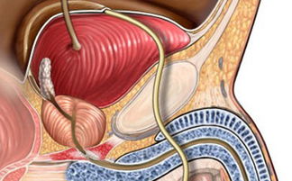 把握前列腺增生的早期预警信号，进行10项预防措施，守护男性健康