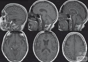 理解脑萎缩：原因、日常措施与防护
防止脑萎缩：八项日常要点，科学的脑健康守护之道