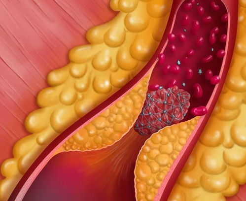 动脉硬化的真相：哪些食物能缓解或逆转病情？让我们与医生一起探索