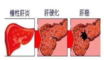 《为何我国是肝癌大国？背后因素值得深入探讨》