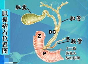 胆囊结石与癌症的准确距离，从哪些方面看出两者间的关联性?