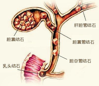 胆囊结石与癌症的准确距离，从哪些方面看出两者间的关联性?