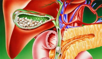 胆囊结石与癌症的准确距离，从哪些方面看出两者间的关联性?